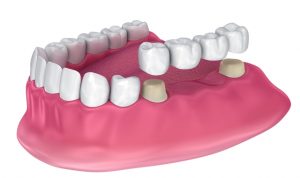 Bridge dentaire pour remplacer les dents manquantes