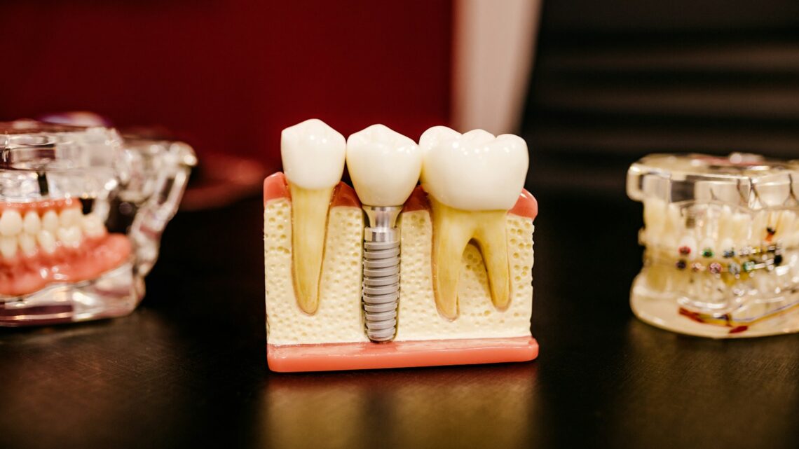 Comprendre les facteurs qui affectent le coût de l’installation d’implants dentaires